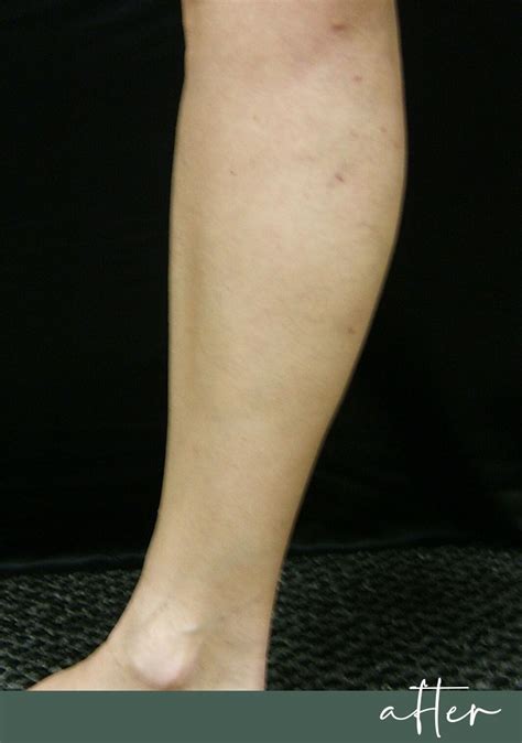 varicose vein treatment mt juliet|Varicose Vein Treatments in Nashville, Franklin & Mt. Juliet.